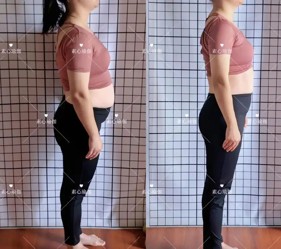 三胎妈妈剖腹产,产后修复前后对比图