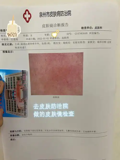 过敏源测试都没什么问题一直反复太烦人了,去皮肤防治院做了皮肤镜我