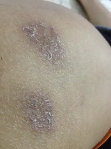 臀部有两处表面有皮屑很痒,有买过治股癣的药膏没有用,请问这是股癣吗