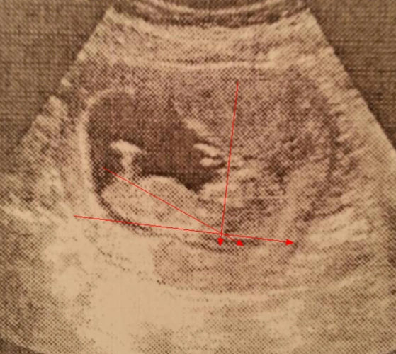 12周nt单子尾椎亮点图孩子裆部有凸起的亮点是男孩