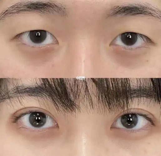 从单眼皮变成双眼皮
