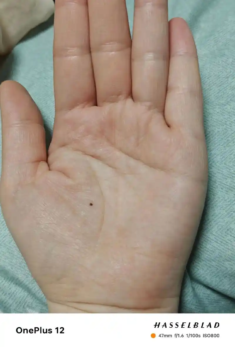 左手手心突然长了一颗痣,曾听人说,左手痣,时来运转.左手突然长痣