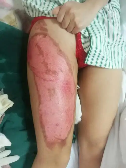 13 张孝美 右大腿热水烫伤