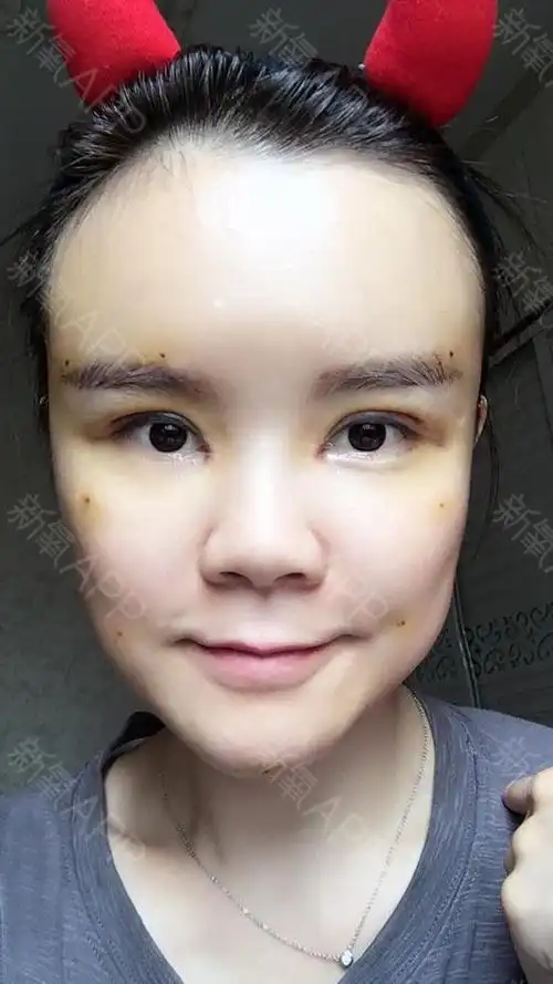 新氧- 氧气57e86b80780ec71 | 面部轮廓 | 自体脂肪填充额头 | 自体