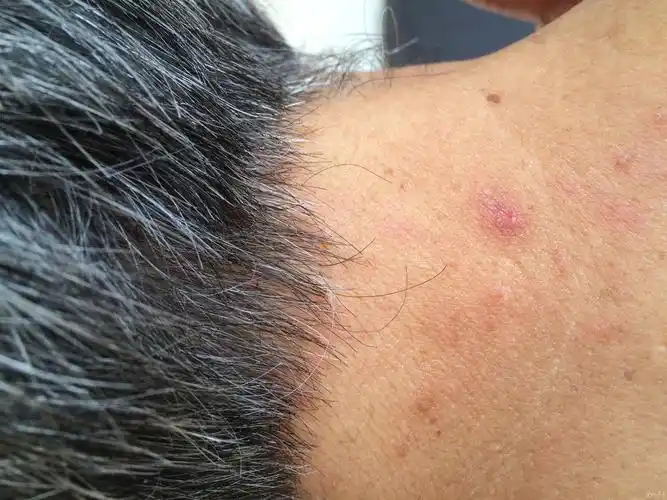 是疥疮吗? - 皮肤及性传播疾病讨论版 - 爱爱医医学论坛