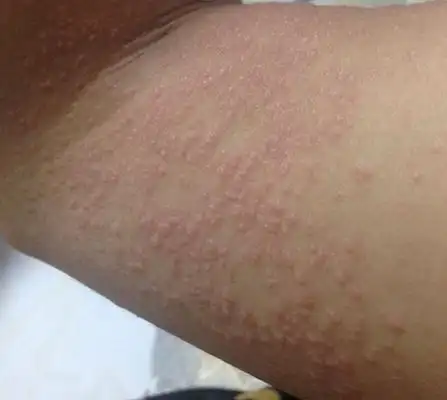 干性湿疹症状图片50