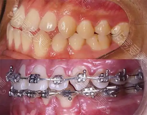 侧面看牙齿矫正前后对比