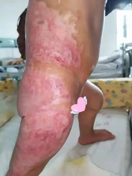 科普知识小儿烫伤是由于幼儿期儿童好奇心强,活动稳定性差,回避反应