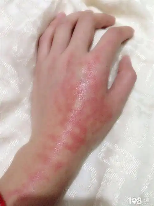 皮肤烫伤怎么办(皮肤烫伤怎么办最快最有效)