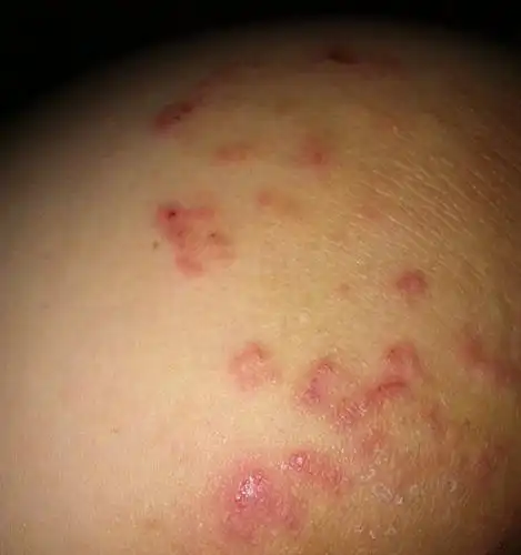 屁股上经常会长红色凸起状颗粒.象被蚊子咬过那种包.