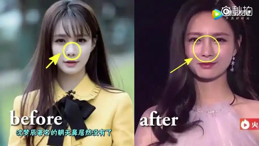 沈梦辰又变脸!猪鼻子整成了鹰钩鼻!