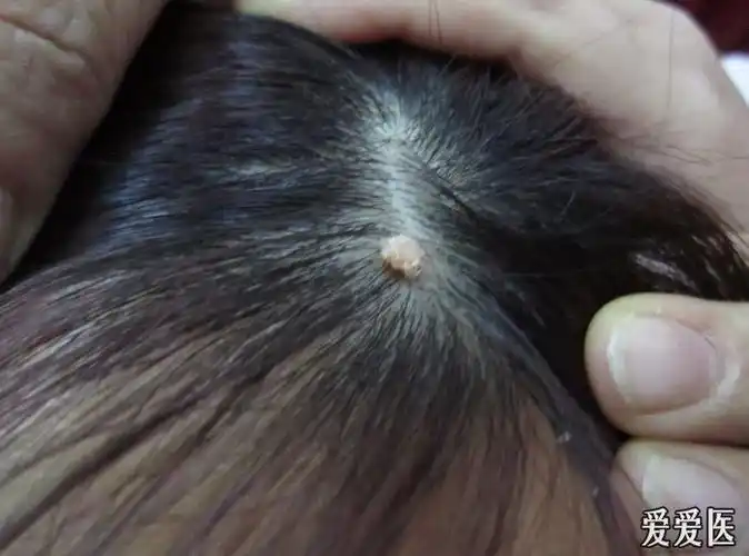 头皮寻常疣