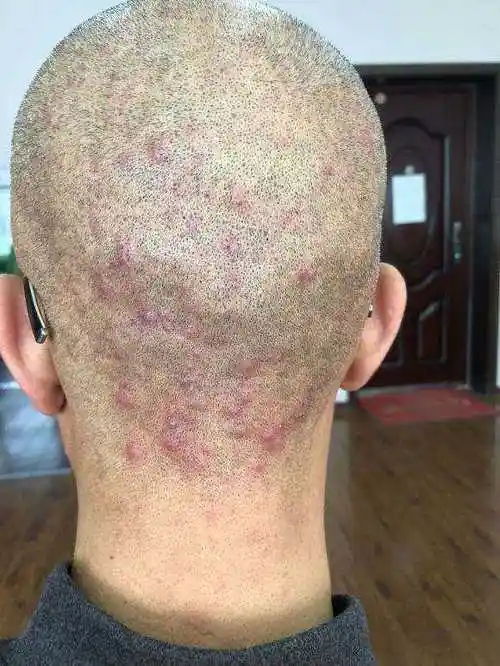 哪些人毛囊炎容易反复发作-惠州皮肤病专科医院哪家好【挂号】惠州