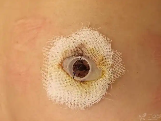 沿设计线切开皮肤,靠近乳头的三角形边不进行分离,另外两边行钝性分离