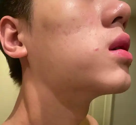 拯救痘印,暗沉脸