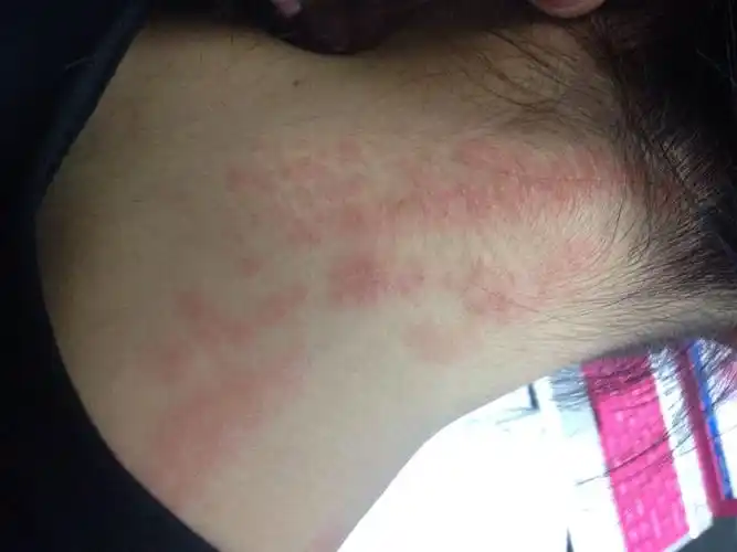 朋友皮肤过敏,附近医院下班了,求助各位专家看一下是什么症状,该如何