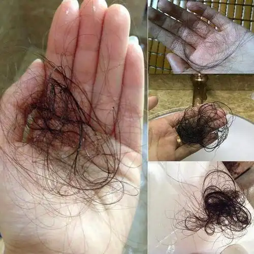 比中年秃顶更让人心烦的就是产后脱发教你一点小常识