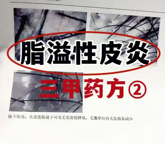 常伴有头屑增多,头皮油腻,瘙痒明显,为了改善我们的脂溢性皮炎,所以