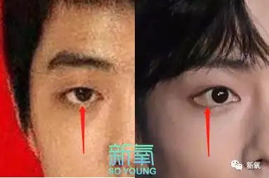 同样的变化,我们可以对比一下眼睑下至手术的前后变化,还是挺像的吧