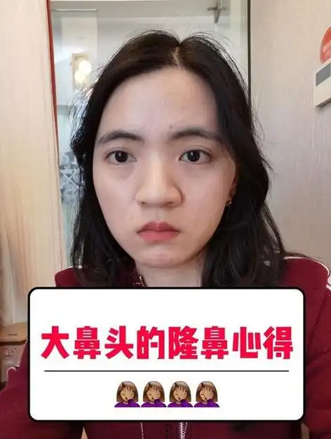 鼻孔缩小手术对比图术后35天的果真的是太明x了叭