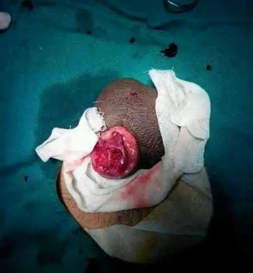 岁少年包茎手术前照片_有来医生