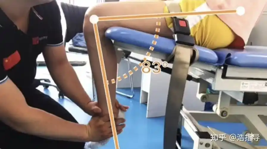 康复故事97——胫骨平台粉碎性骨折术后5个月卡在70度,六次掰腿实现