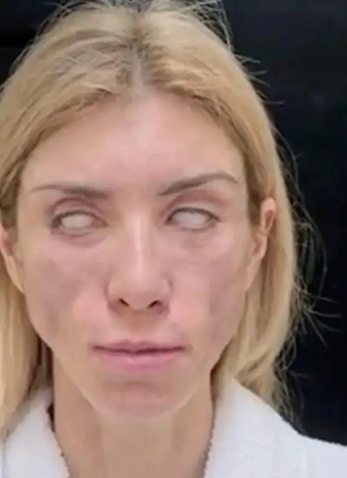 哭死41岁选美小姐整形失败竟变死人脸一闭眼吓死人再也不能笑