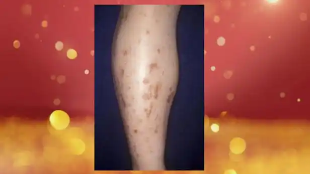 《养生堂》观下肢识"糖斑"