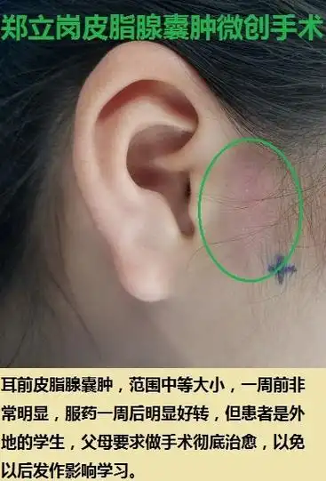 耳前皮脂腺囊肿微创切除术第6湖南衡阳长宁雷