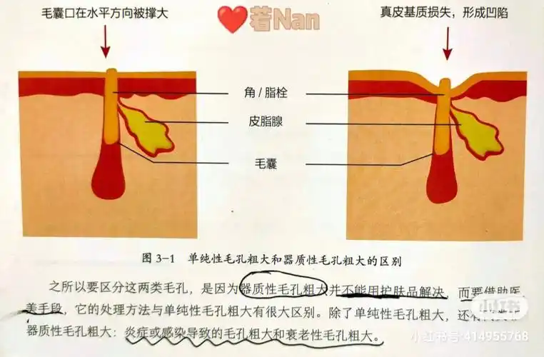 毛孔粗大的分类(二)