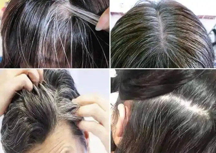 按摩10分钟白发变黑发,不伤头皮,毛囊 ,100%覆盖!