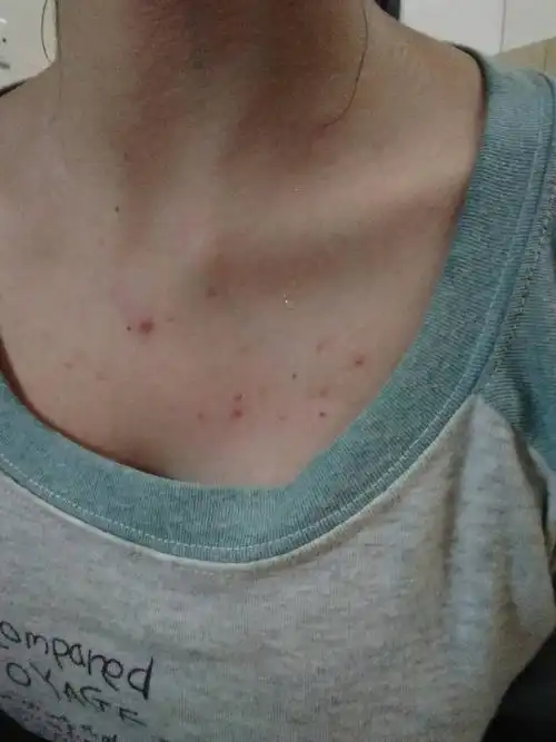 胸前长痘痘啥原因.去年暑假发现长痘痘!