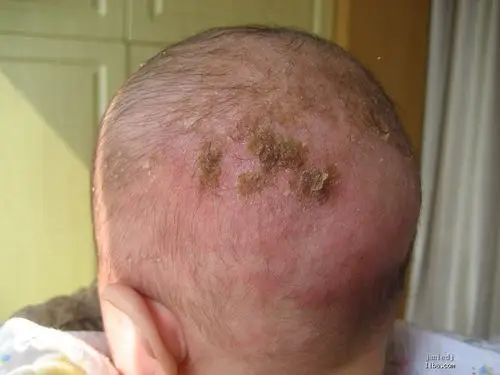 婴儿头皮湿疹结痂