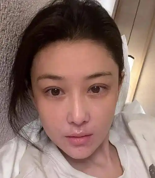 张馨予分享素颜近照,皮炎复发面部出现疤痕,透露爆发期很吓人!