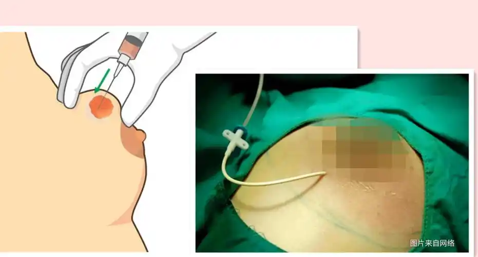 脓肿形成之后:若脓肿范围较小,则可在超声引导下穿刺抽脓引流,置管