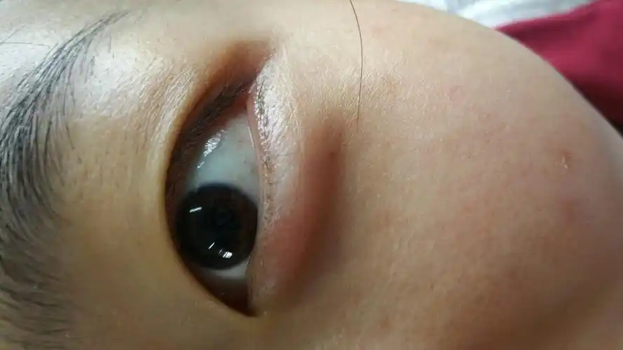 眼袋肿痛怎么办 从昨天晚上开始的