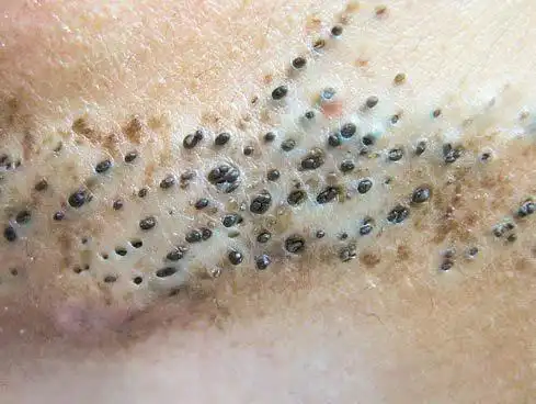 粉刺?黑头粉刺痣