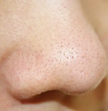 毛孔堵塞毛孔粗大 解决方案