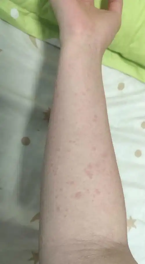 吃完龙虾就过敏了,全身大面积红斑疙瘩,从头皮到脚面奇痒无比
