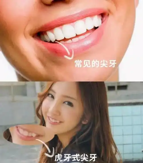 虎牙这么可爱为什么要矫正虎牙