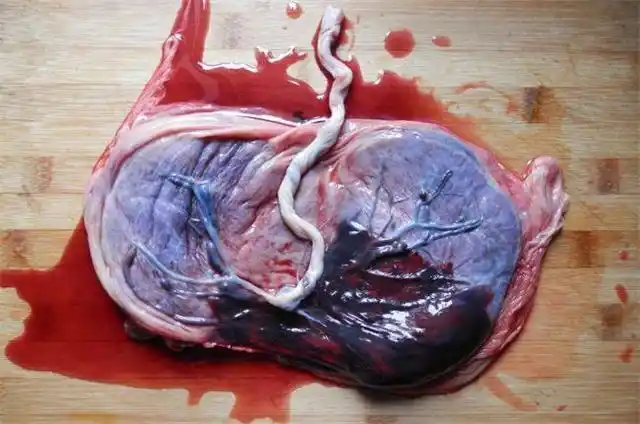 中医名著《本草纲目》也称人胎盘为紫河车,提到:紫河车具有"安神养血