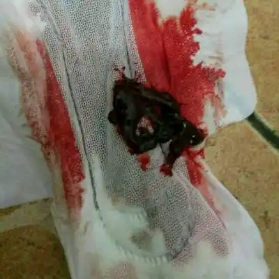 附上照片,希望大家不要被恶心到,每个月月经都会有好多瘀血,真的是