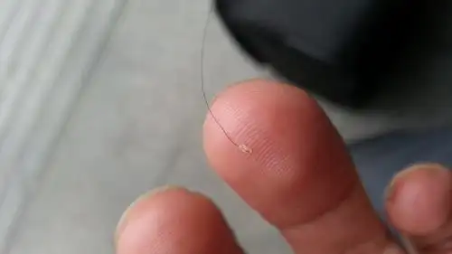 脱发再生发根很浅容易掉发根很油怎么办