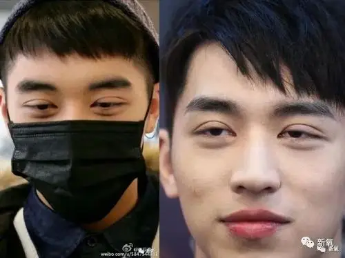 双眼皮的整形痕迹一般分两部分,闭眼痕迹重,但没有肉条.