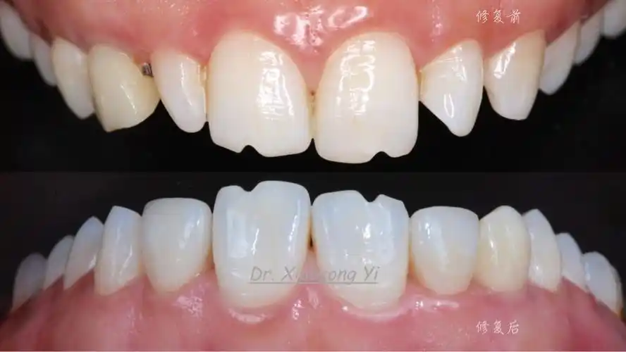 双侧上颌侧切牙发育畸形,贴面修复帮助恢复良好形态