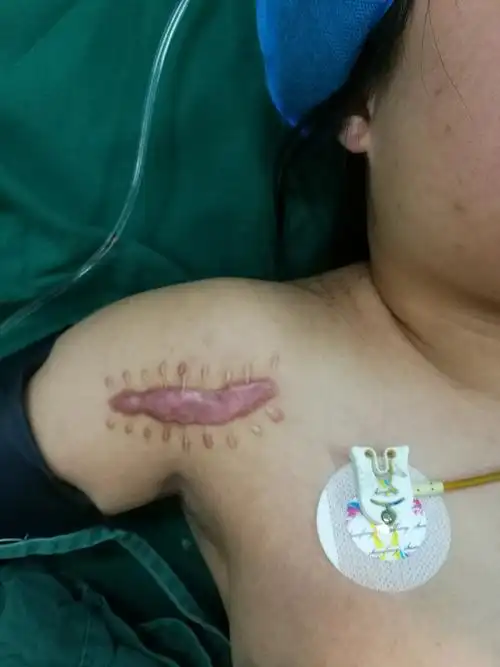 开展伤口美容缝合新项目