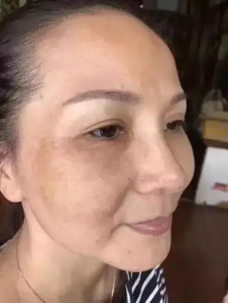 35岁满脸斑怎么办娇碧泉助您3天淡斑