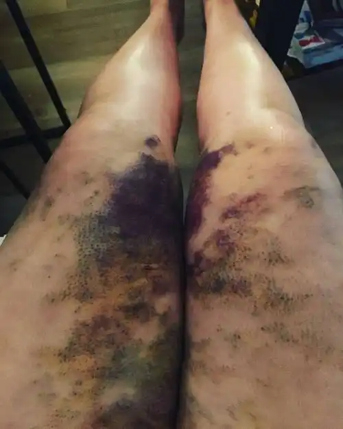 吸脂抽脂有哪些后遗症? - 知乎