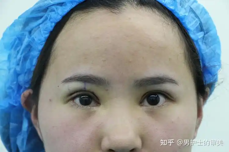 单侧上睑下垂修复3个月小姑娘双眼皮流畅眼睛对称