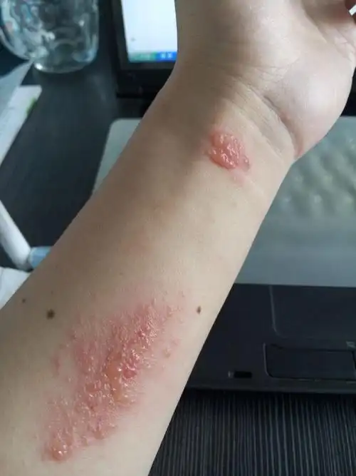 干了点活,手臂一开始红肿很痒,第二天 起小水泡 ,到了傍晚小水泡变大
